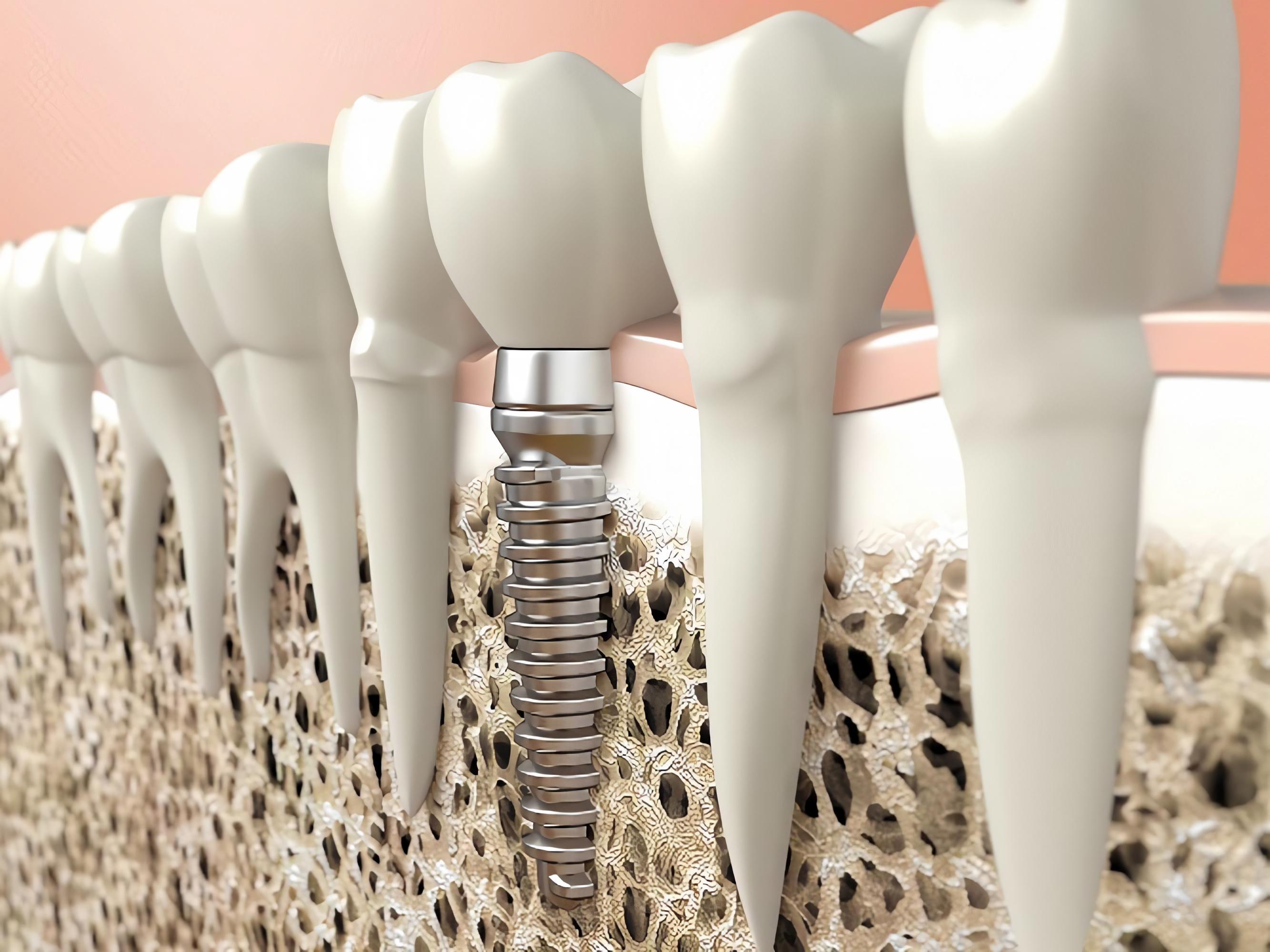 Osteoporosis and dental implants