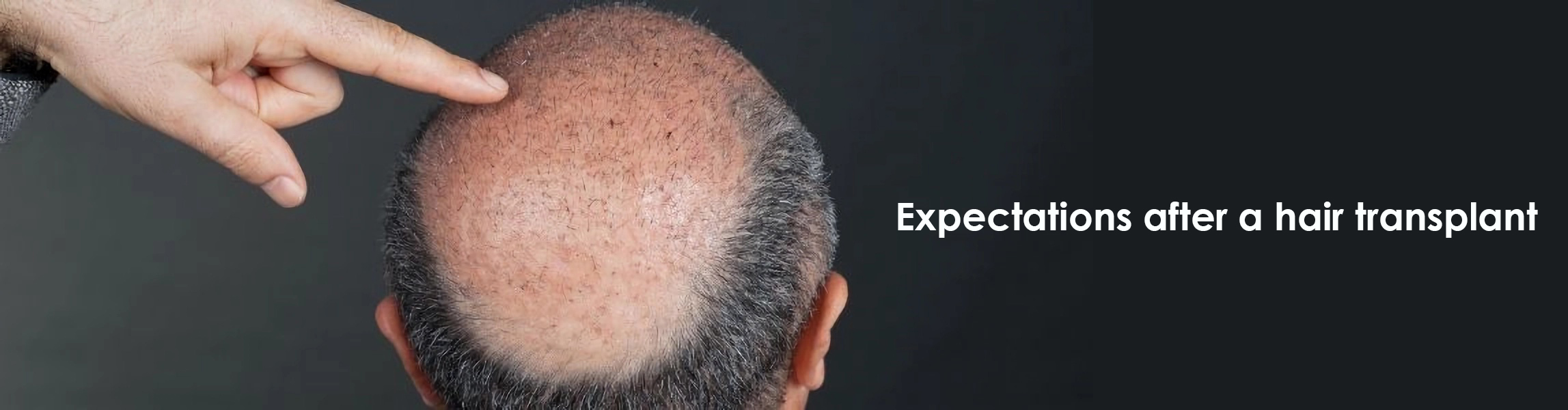 Expectations after hair transplantation