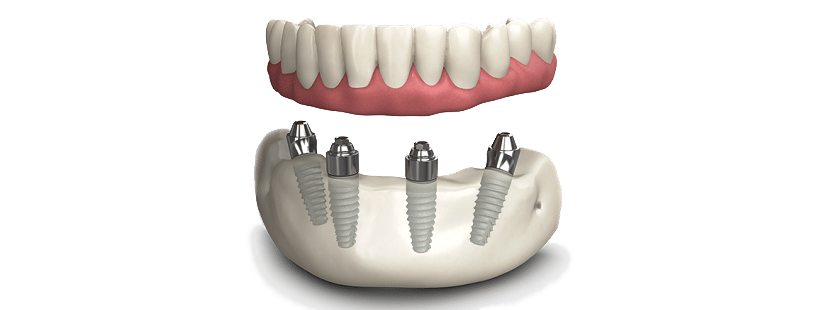 How implants are attached to the jaw at All on 4 