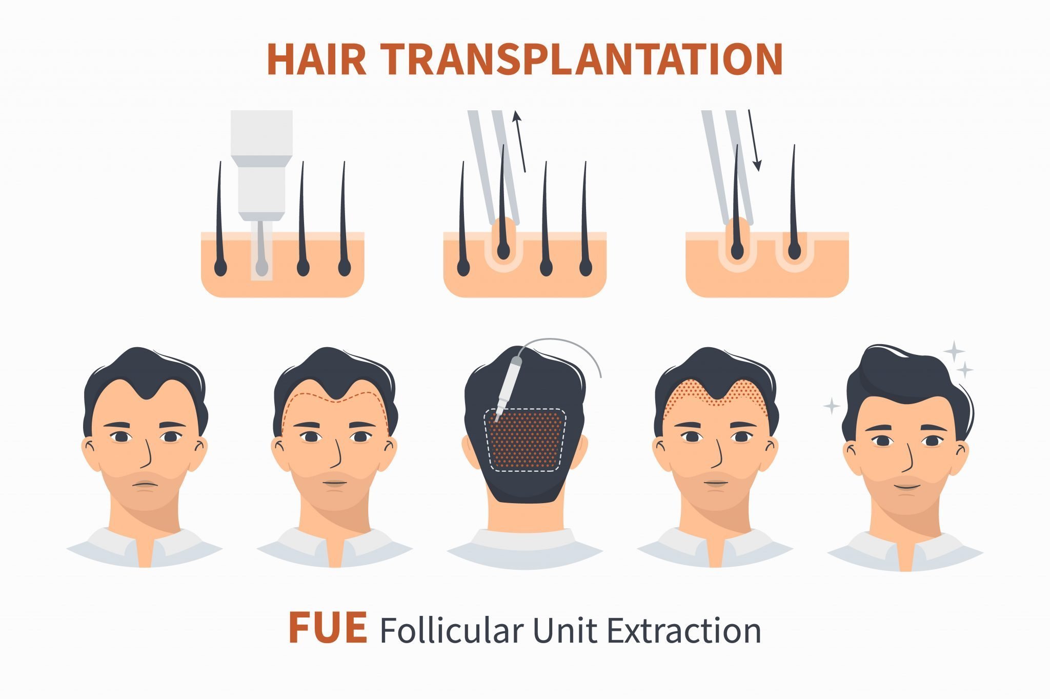 FUE Hair Transplant Method